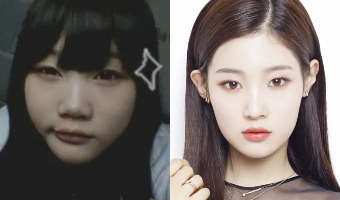 jung-chaeyeon-plastic-surgery.png